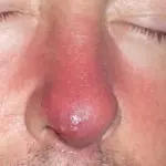 фурункул на носу у мужчині